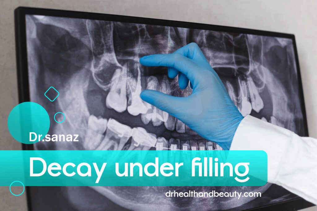 decay under filling - by dr.sanaz