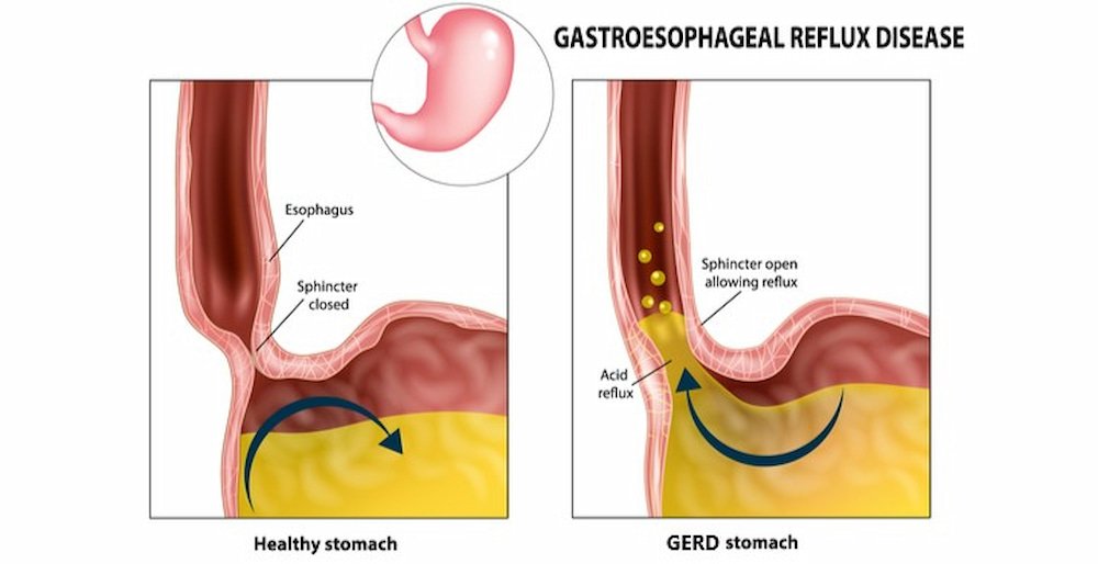 gastroesophageal reflux disease (GERD) 741