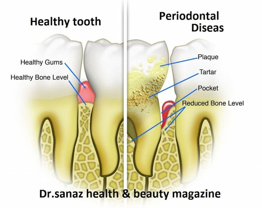 periodontal Doseas 88002