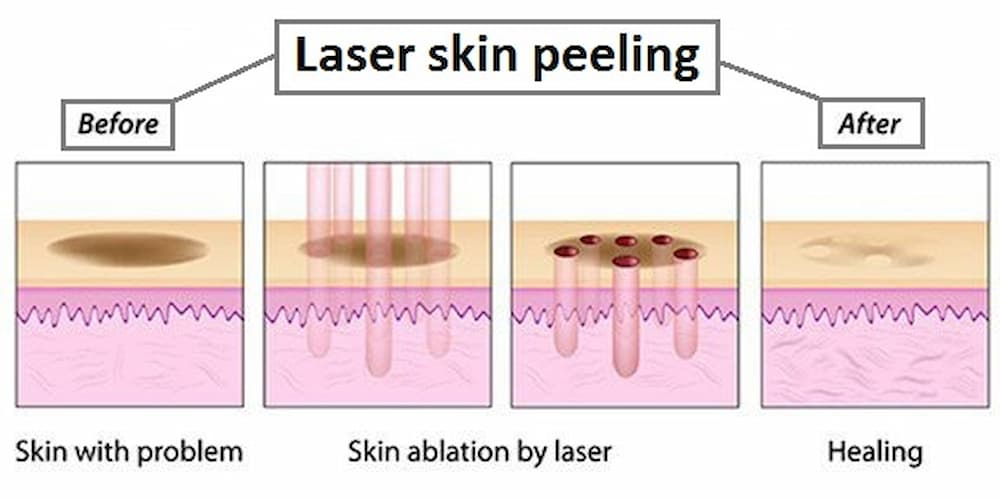 Laser skin peeling before and after