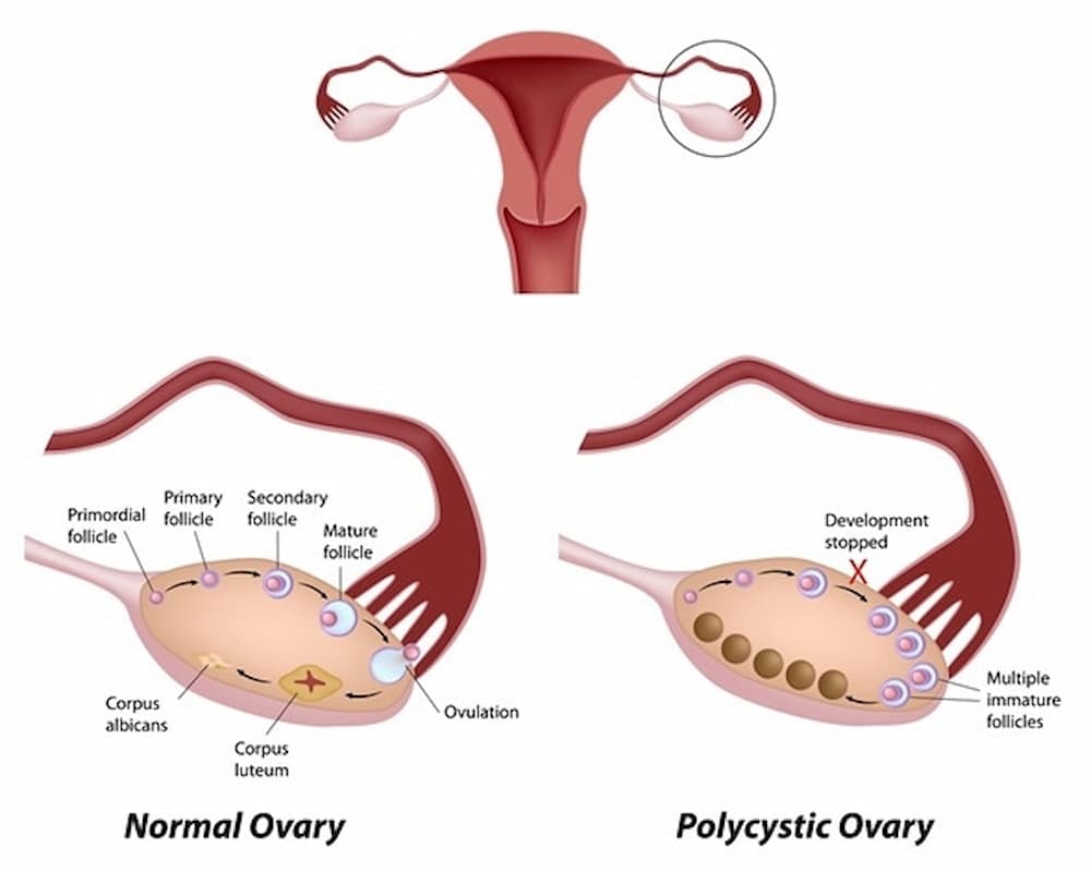 Polycystic ovary syndrome 11101