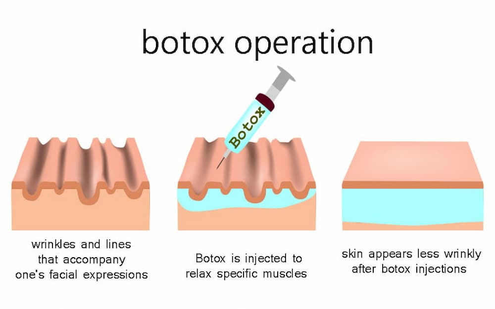 Botox operation 00010