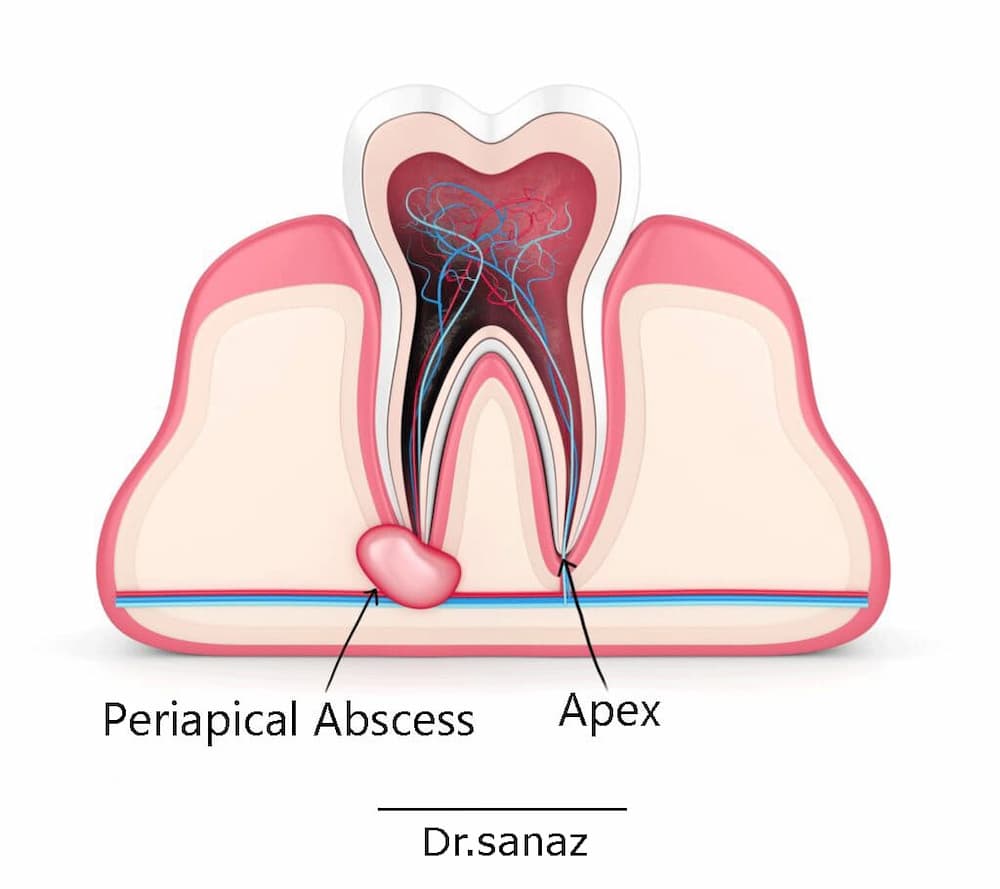 Periapical abscess 0041