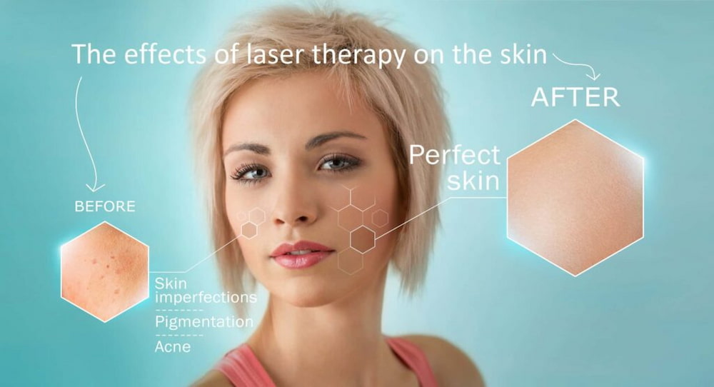 Laser therapy and skin