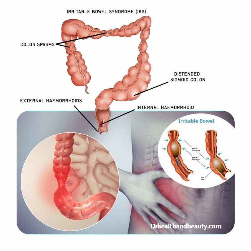 Irritable bowel syndrome (IBS) 99557