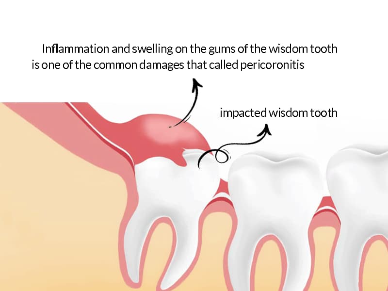 What should I do with the pain of wisdom tooth decay?