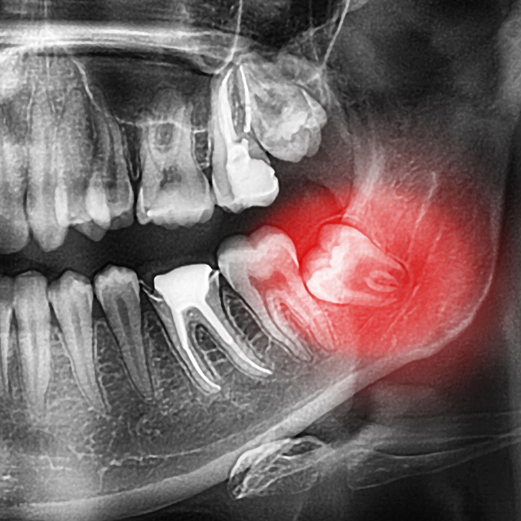 What should I do with the pain of wisdom tooth decay?