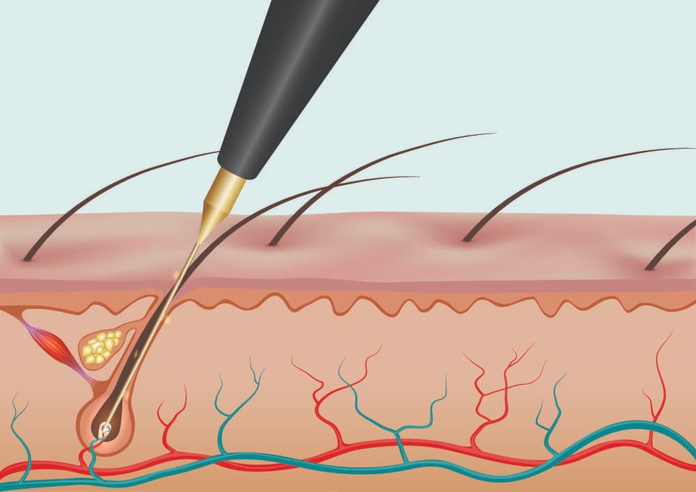 What is the most permanent method of hair removal?