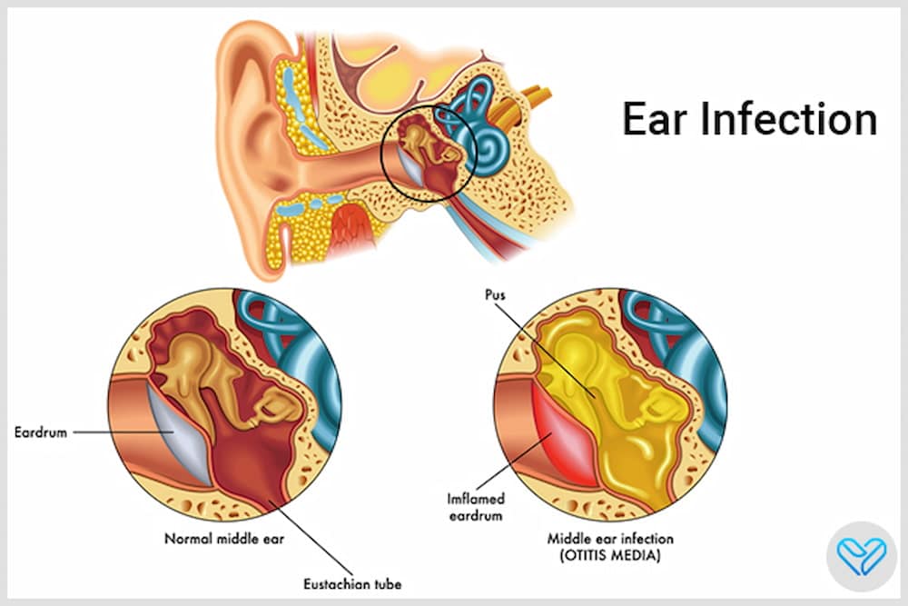 ear infection 998877