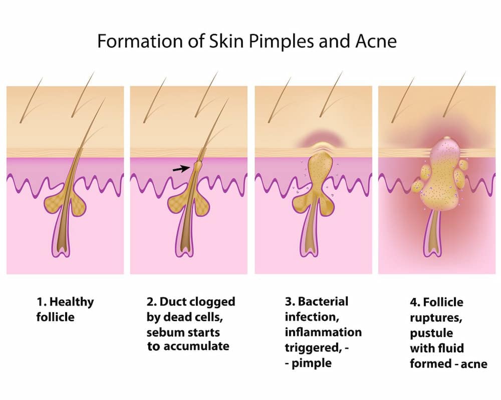 how does acne form?