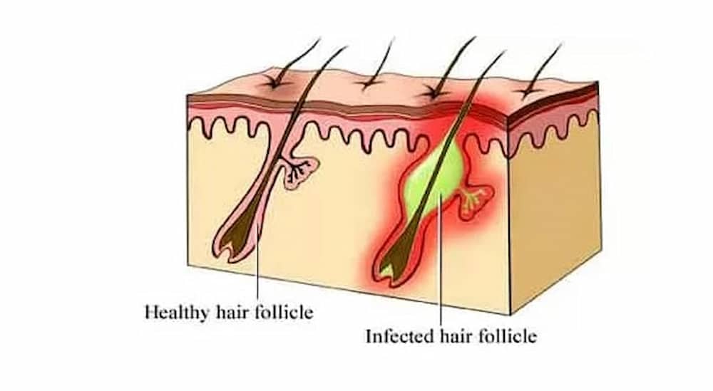 healthy vs infected hair follicle