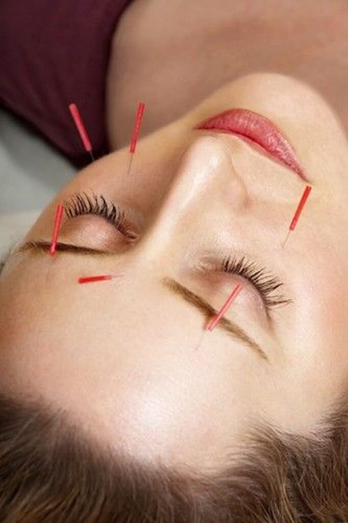 face acupuncture for allergy