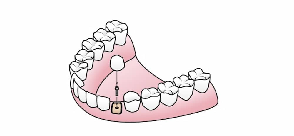 Endosteal Teeth Implant method 001
