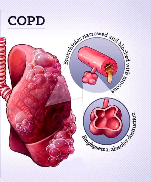 COPD - DR.SANAZ 2
