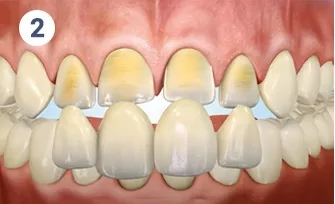 How To Laminate Teeth And How Long Does It Work?