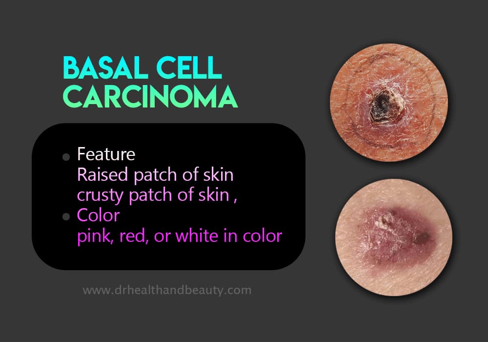 Basal cell carcinoma 124524