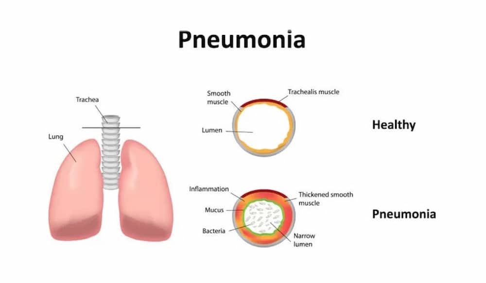 pneumonia - Stages Of Cold In Babies/ Post-Pandemy Concerns