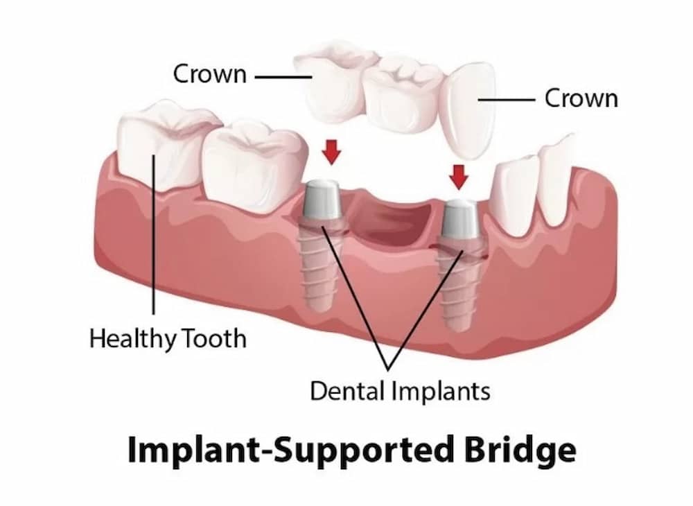 Tooth Implants by bridge method 0001