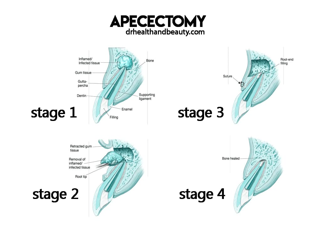 apicoectomy 00112541