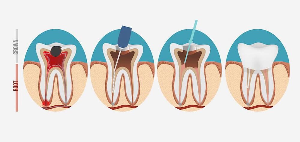 stage of root canal treatment