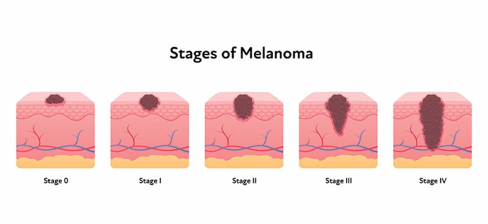 stages of melanoma
