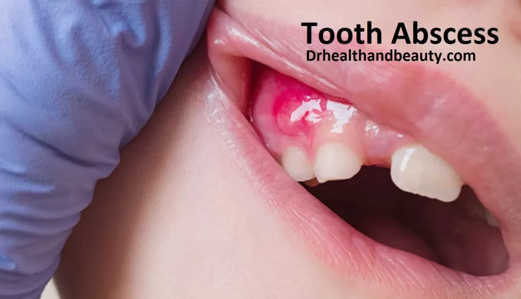 Tooth Abscess-Gingivitis