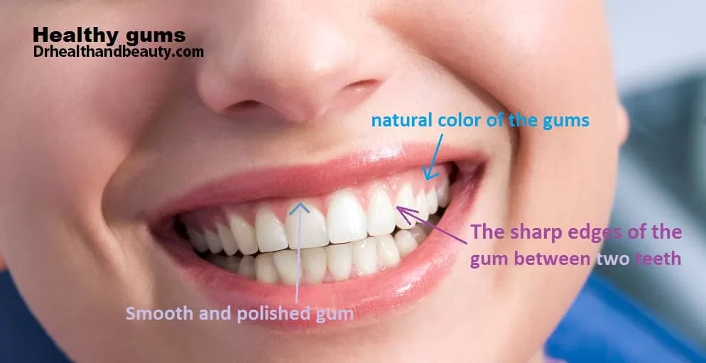 Healthy gums-Gingivitis