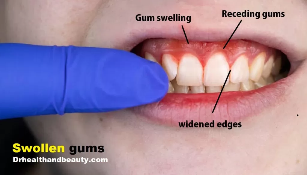 Swollen gums-Gingivitis