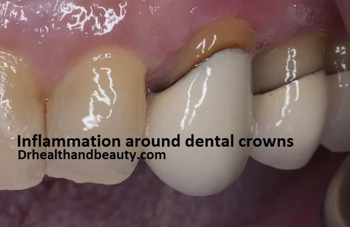 Inflammation around dental crowns-Gingivitis