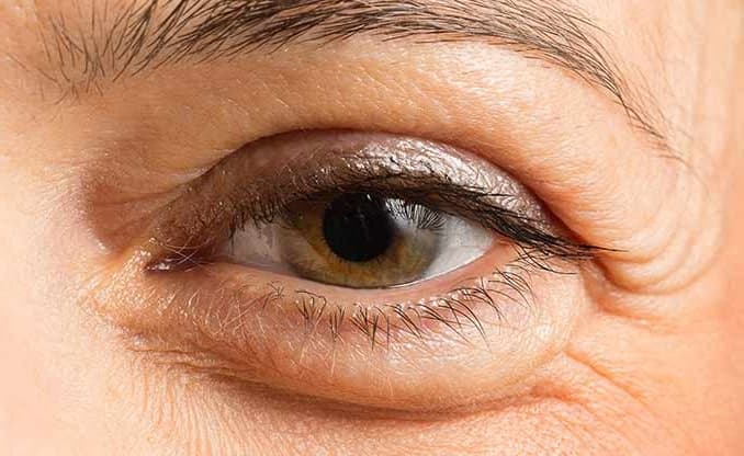 Cosmetic Upper Eyelid Surgery/Blepharoplasty-2