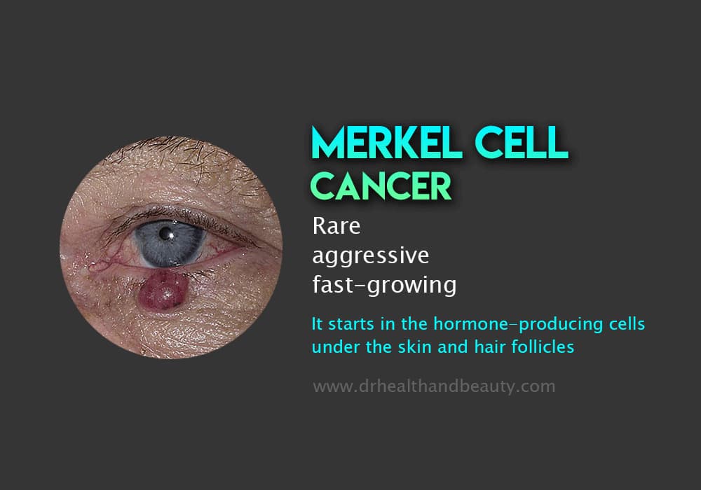 Merkel-cell-cancer
