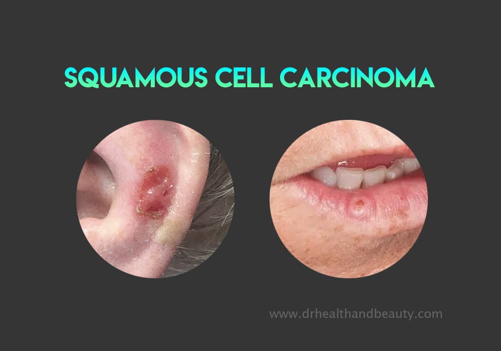 Squamous-cell-carcinoma-(SCC)