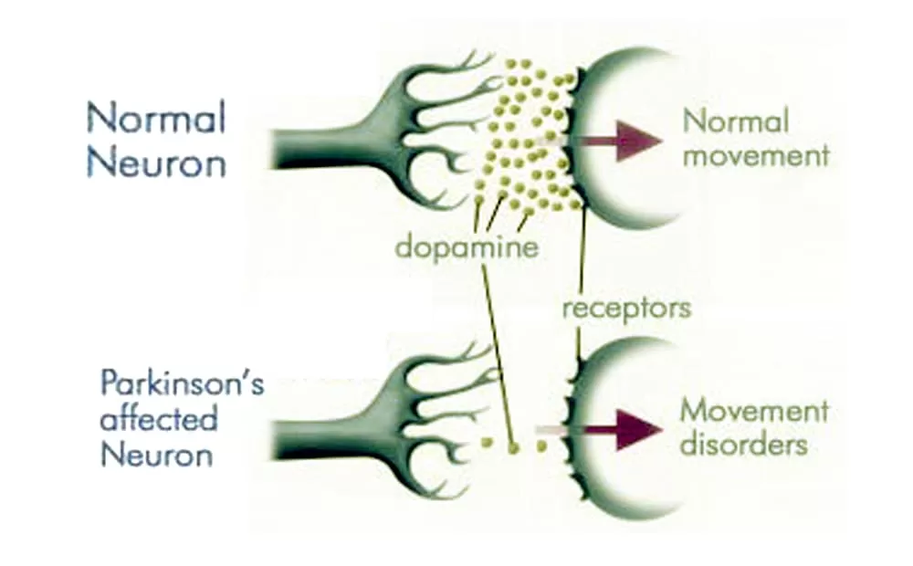Can Parkinson's Dementia Kill You?