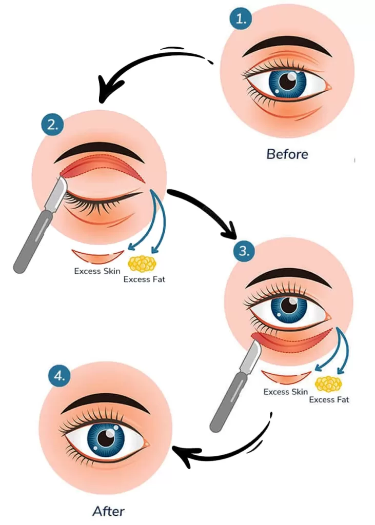 Cosmetic Upper Eyelid Surgery/Blepharoplasty-6