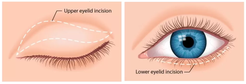 Cosmetic Upper Eyelid Surgery/Blepharoplasty-3
