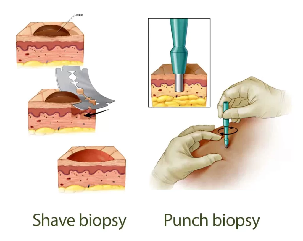 basal cell carcinoma diagnosed - biopsy
