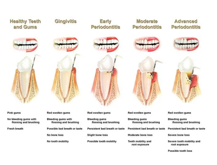 periodontal-disease-Gingivitis