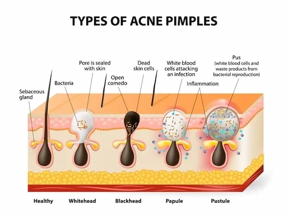 type of acne pmple 5258
