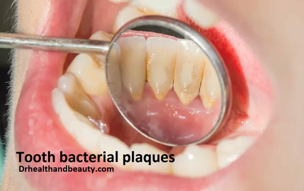 Gingivitis-dental bacterial plaques-