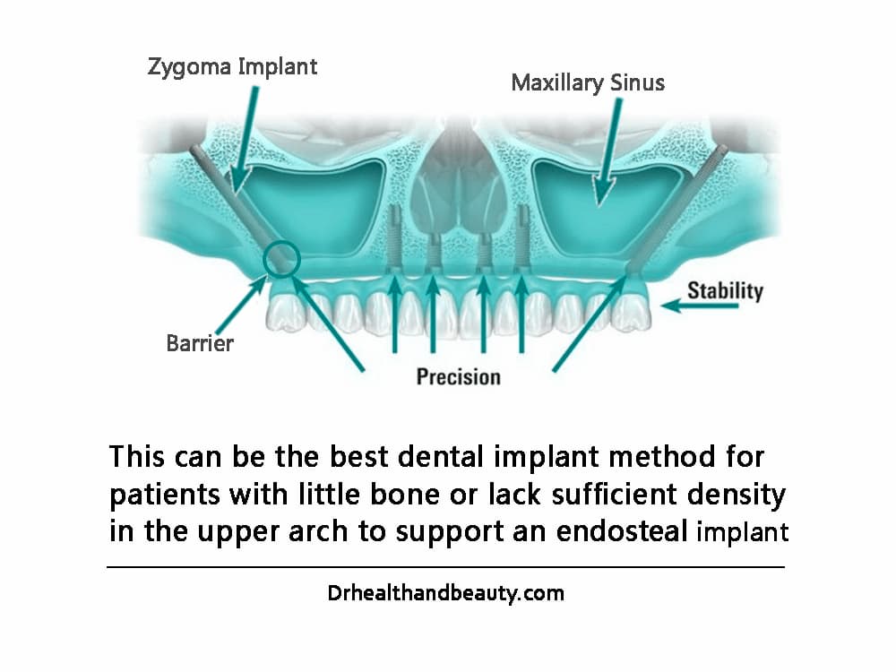 zygmotic-implant