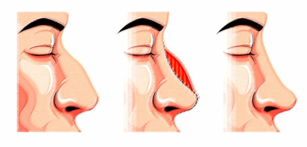 What-Are-The-Risks-Factors-Of-Rhinoplasty 2