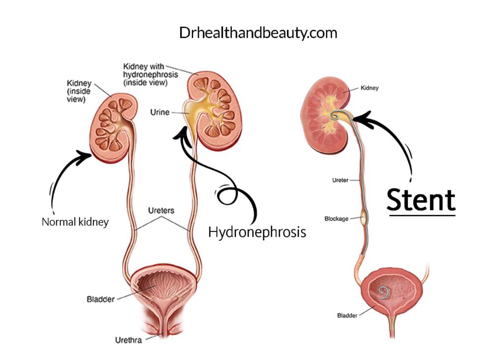 stent -hydronephrosis