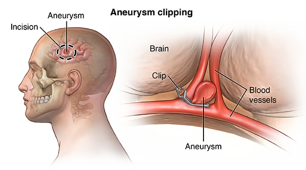 Aneurism clipping