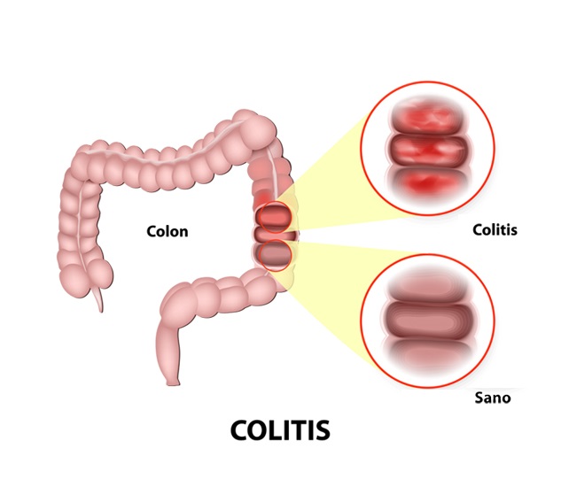 Colitis Ulcerative