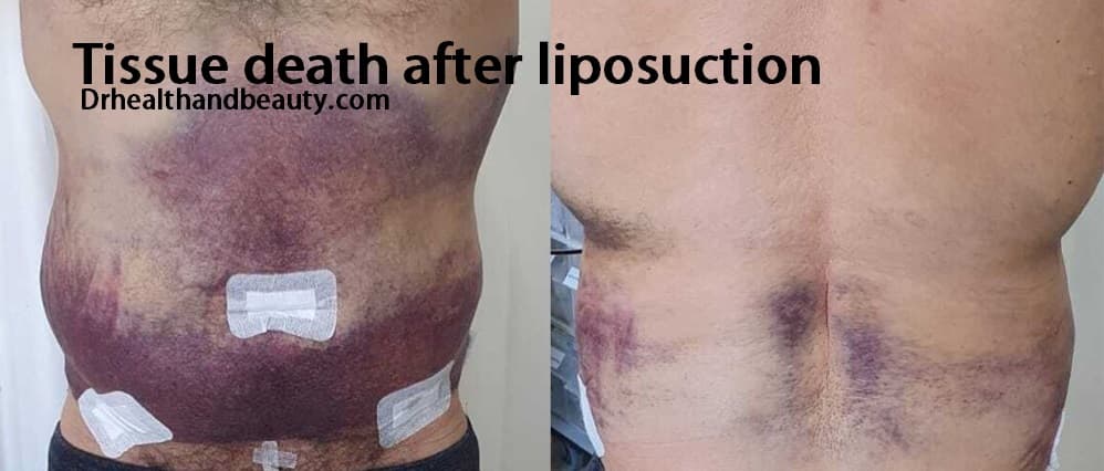 tissue death after liposuction