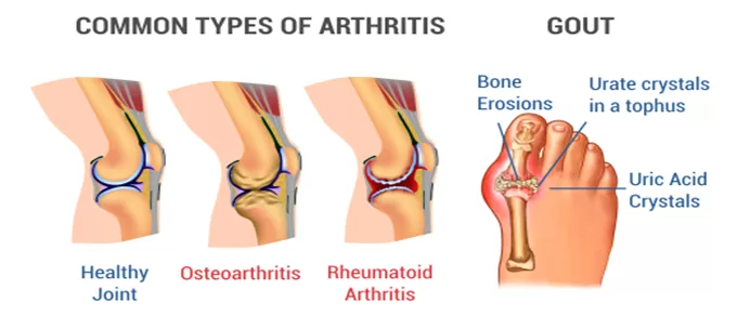 Osteoarthritis and Gout