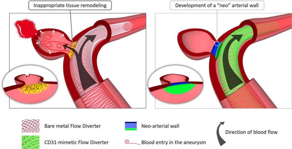 Diverting Stent for brain Aneurysm