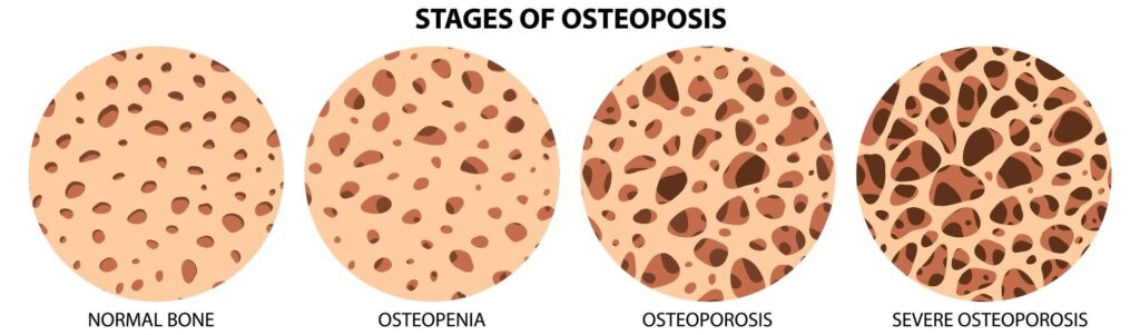 stage of osteoporosis