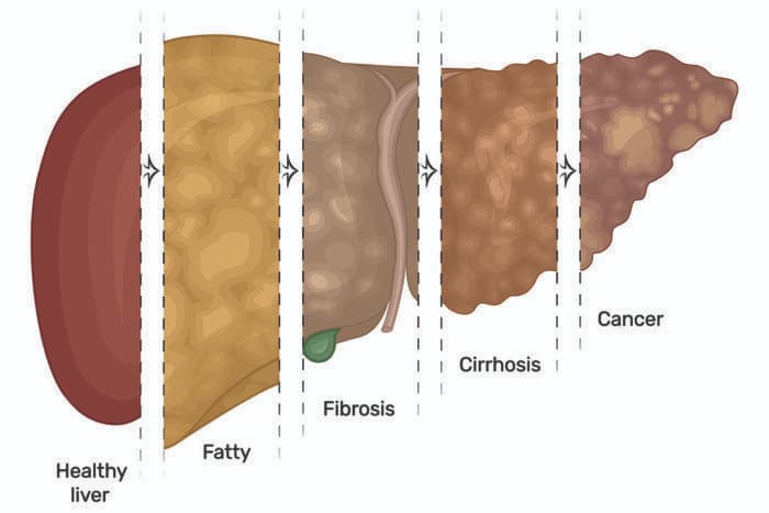 fatty liver - Cirrhosis - cancer