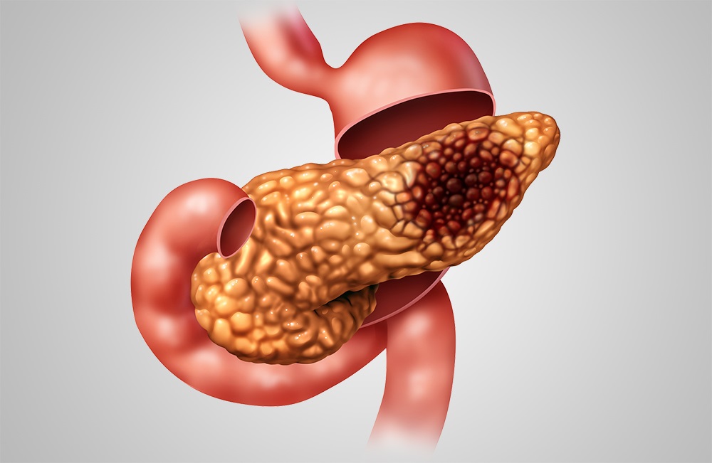 Infections after Pancreas Transplant